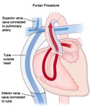 Fontan Procedure