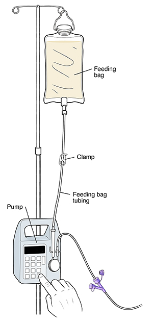 Feeding bag hanging from pole on pump. Feeding bag tubing goes from bag to pump. Clamp is in middle of tubing.